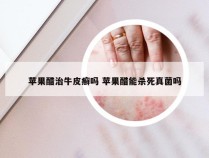 苹果醋治牛皮癣吗 苹果醋能杀死真菌吗