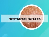 用姜擦牛皮癣管用吗 姜治牛皮癣吗