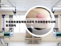 牛皮癣患者能喝普洱茶吗 牛皮癣患者可以喝普洱茶吗