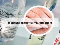 银屑病可以打激素针治疗吗 银屑病能打