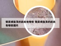 银屑病复发的前兆有哪些 银屑病复发的前兆有哪些图片