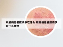 银屑病患者应该多吃什么 银屑病患者应该多吃什么食物