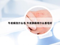 牛皮癣洗什么皂 牛皮肤癣用什么香皂好