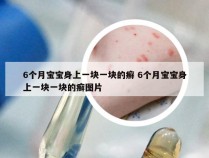 6个月宝宝身上一块一块的癣 6个月宝宝身上一块一块的癣图片