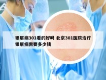银屑病301看的好吗 北京301医院治疗银屑病需要多少钱