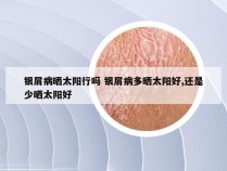 银屑病晒太阳行吗 银屑病多晒太阳好,还是少晒太阳好