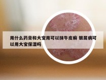 用什么药膏和大宝用可以抹牛皮癣 银屑病可以用大宝保湿吗