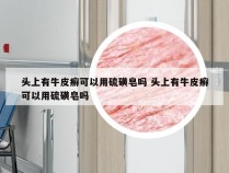 头上有牛皮癣可以用硫磺皂吗 头上有牛皮癣可以用硫磺皂吗