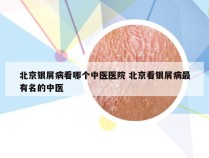 北京银屑病看哪个中医医院 北京看银屑病最有名的中医