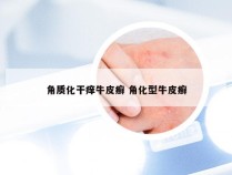 角质化干痒牛皮癣 角化型牛皮癣