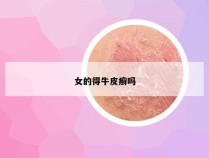女的得牛皮癣吗