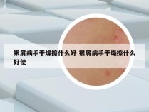 银屑病手干燥擦什么好 银屑病手干燥擦什么好使