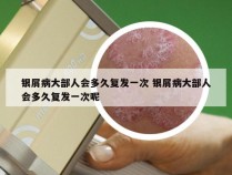 银屑病大部人会多久复发一次 银屑病大部人会多久复发一次呢