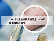 2023年6月治疗银屑病消息 2030年能根治银屑病吗