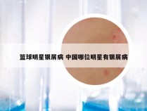 篮球明星银屑病 中国哪位明星有银屑病