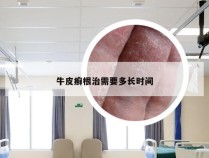 牛皮癣根治需要多长时间