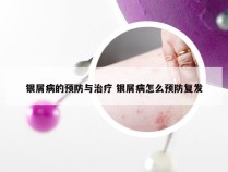 银屑病的预防与治疗 银屑病怎么预防复发