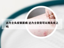 达力士头皮银屑病 达力士软膏可以用头皮上吗