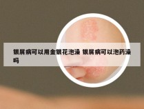 银屑病可以用金银花泡澡 银屑病可以泡药澡吗