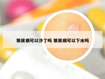 银屑病可以沙了吗 银屑病可以下水吗