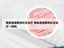 银屑病湿敷和红光治疗 银屑病湿敷和红光治疗一样吗