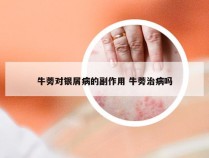 牛蒡对银屑病的副作用 牛蒡治病吗