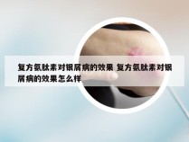 复方氨肽素对银屑病的效果 复方氨肽素对银屑病的效果怎么样