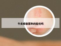 牛皮癣韭菜熟的能吃吗