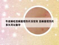 牛皮癣吃百癣夏塔热片没见效 百癣夏塔热片多久可以备孕