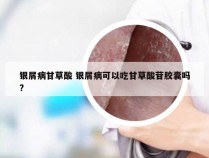 银屑病甘草酸 银屑病可以吃甘草酸苷胶囊吗?