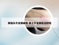 脚指头牛皮癣破裂 脚上牛皮癣能治好吗