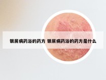 银屑病药浴的药方 银屑病药浴的药方是什么