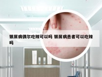 银屑病偶尔吃辣可以吗 银屑病患者可以吃辣吗