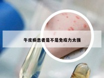 牛皮癣患者是不是免疫力太强