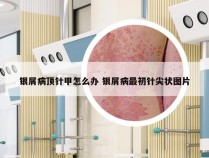 银屑病顶针甲怎么办 银屑病最初针尖状图片