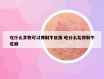 吃什么食物可以抑制牛皮癣 吃什么能抑制牛皮癣