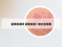 副银屑病块 副银屑病一般长在哪里