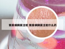 银屑病鳞屑注射 银屑病鳞屑注射什么药