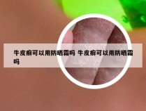 牛皮癣可以用防晒霜吗 牛皮癣可以用防晒霜吗