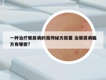 一种治疗银屑病的祖传秘方胶囊 治银屑病偏方有哪些?