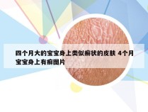 四个月大的宝宝身上类似癣状的皮肤 4个月宝宝身上有癣图片