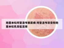 地塞米松阿昔洛韦银屑病 阿昔洛韦软膏和地塞米松乳膏能混用