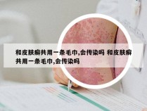 和皮肤癣共用一条毛巾,会传染吗 和皮肤癣共用一条毛巾,会传染吗