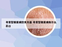 寻常型银屑病饮食方面 寻常型银屑病有什么忌口