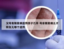 父母有银屑病遗传孩子几率 母亲银屑病儿子和女儿哪个遗传