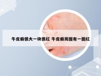 牛皮癣很大一块很红 牛皮癣周围有一圈红