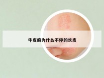 牛皮癣为什么不停的长皮