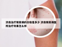 济南治疗银屑病的价格是多少 济南银屑病医院治疗效果怎么样