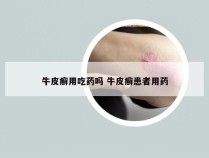 牛皮癣用吃药吗 牛皮癣患者用药