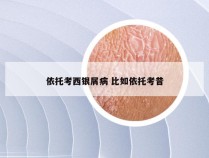依托考西银屑病 比如依托考昔